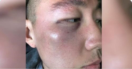 LA 한인타운에서 증오범죄 폭행을 당한 한인 데니 김씨[트위터 게시물 캡처]